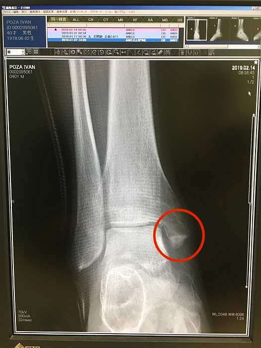 fractura tobillo derecho consolidacion